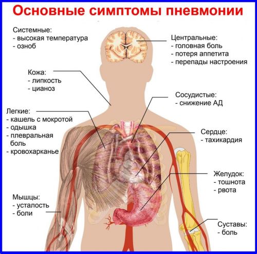 Симптомы пневмонии